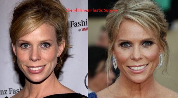 Cheryl Hines Plastic Surgery