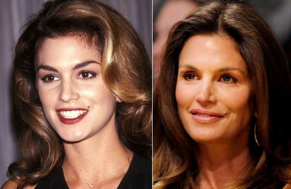 Cindy Crawford Plastic Surgery Before After