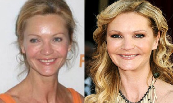 Joan Allen Plastic Surgery Before After