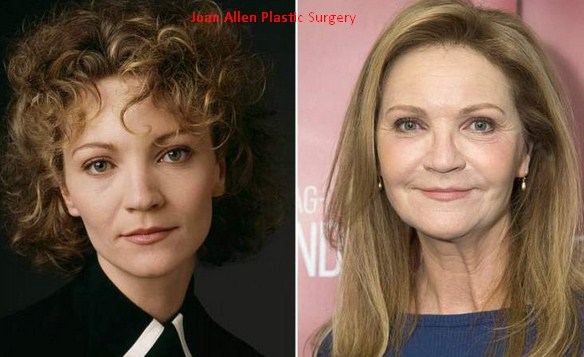 Joan Allen Plastic Surgery
