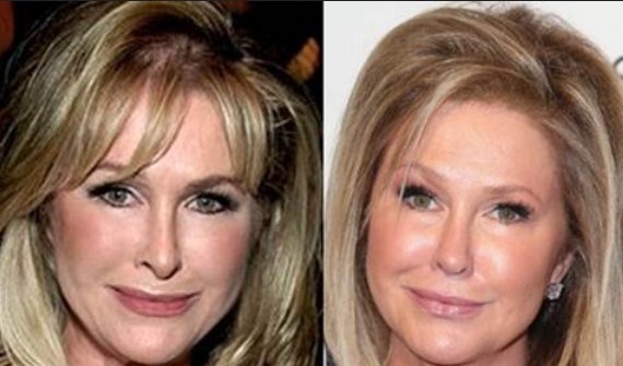 Kathy Hilton Plastic Surgery Picture