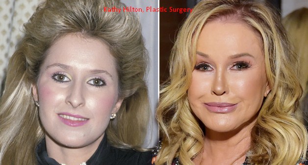 Kathy Hilton Plastic Surgery
