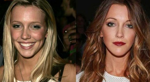 Katie Cassidy Plastic Surgery Before After