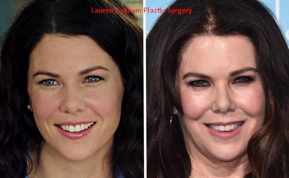 Lauren Graham Plastic Surgery