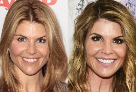 Lori Loughlin Plastic Surgery Before After