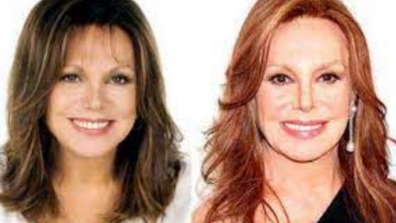 Marlo Thomas Plastic Surgery Before After