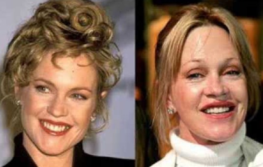 Melanie Griffith Plastic Surgery Before After
