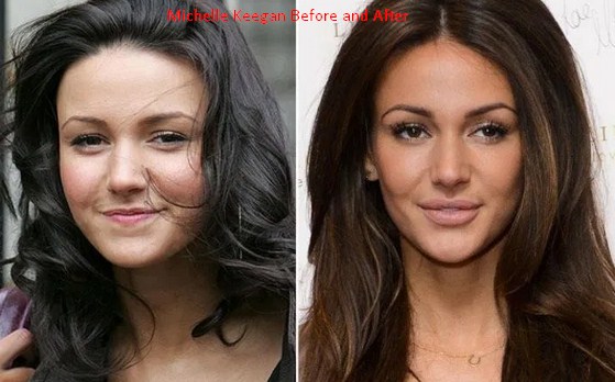 Michelle Keegan Plastic Surgery Before After
