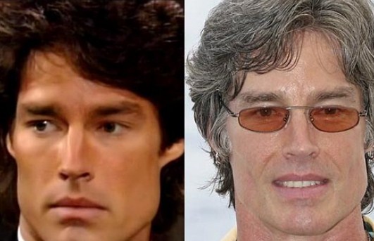 Ronn Moss Plastic Surgery Before After