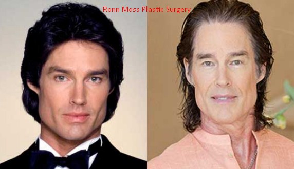 Ronn Moss Plastic Surgery