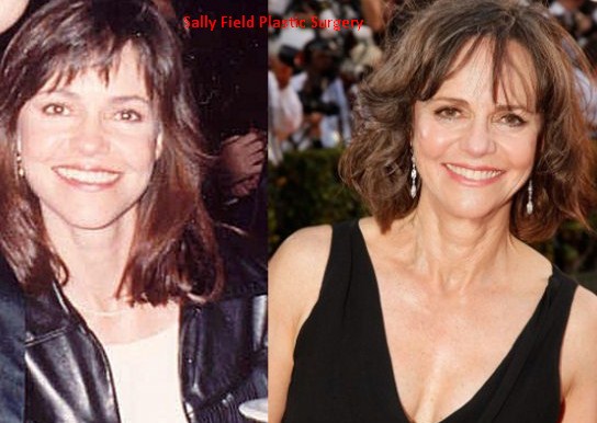 Sally Field Plastic Surgery