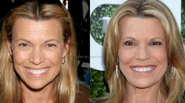 Vanna White Plastic Surgery Facelift