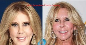 UPDATED! Vicki Gunvalson Plastic Surgery Before After 2022