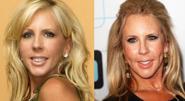 Vicki Gunvalson Plastic Surgery Before After