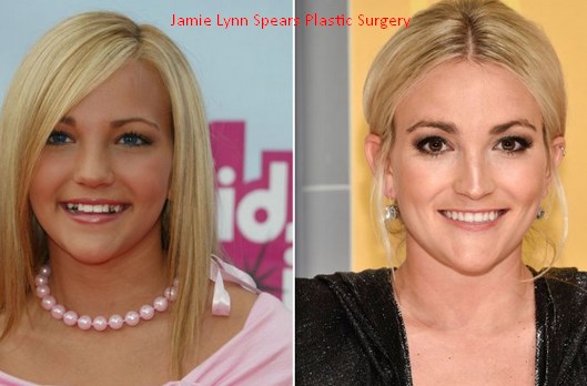 Jamie Lynn Spears Plastic Surgery