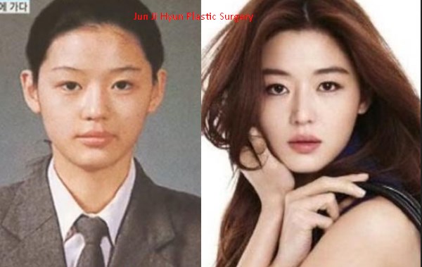 Jun Ji Hyun Plastic Surgery