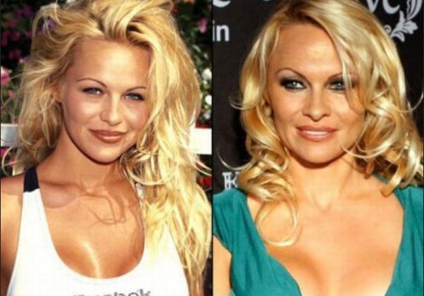 Pamela Anderson Plastic Surgery Before After