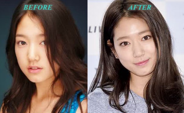 Park Shin Hye Plastic Surgery Before After