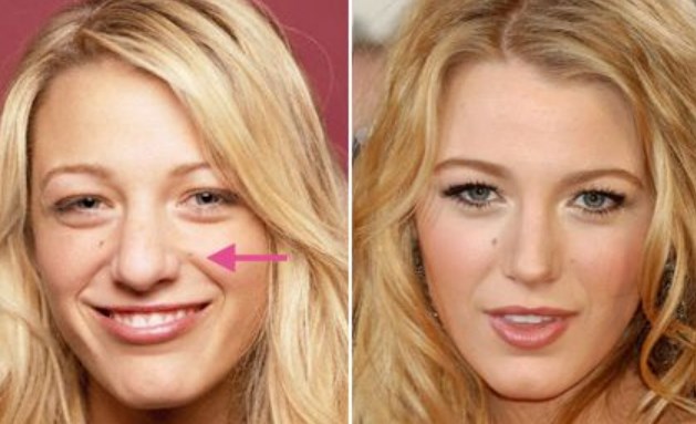 Blake Lively Nose Job