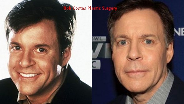 Bob Costas Plastic Surgery