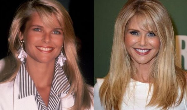 Christie Brinkley Plastic Surgery Before After