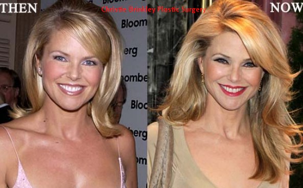 Christie Brinkley Plastic Surgery