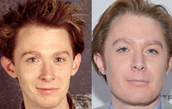 Clay Aiken Plastic Surgery Before After