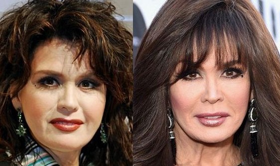 Marie Osmond Facelift