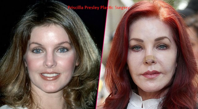 Priscilla Presley Plastic Surgery