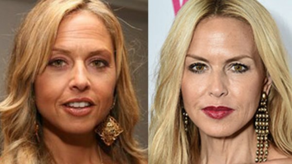 Rachel Zoe Plastic Surgery Before After