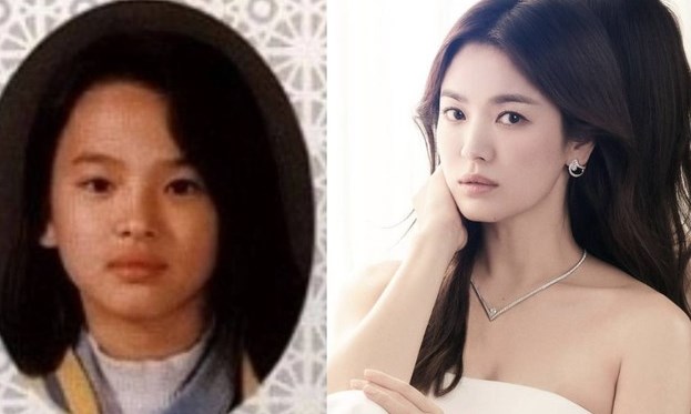 Song Hye Kyo Plastic Surgery Transformation