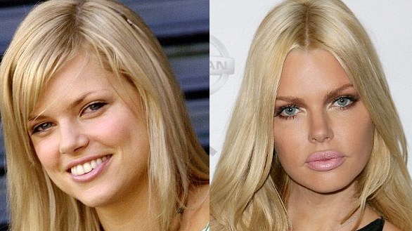 Sophie Monk Plastic Surgery Before After