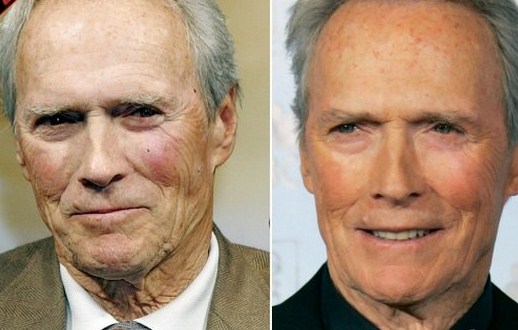 Clint Eastwood Plastic Surgery Before After
