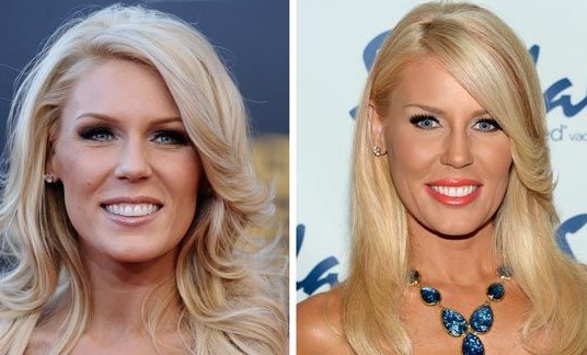 Gretchen Rossi Plastic Surgery Before After