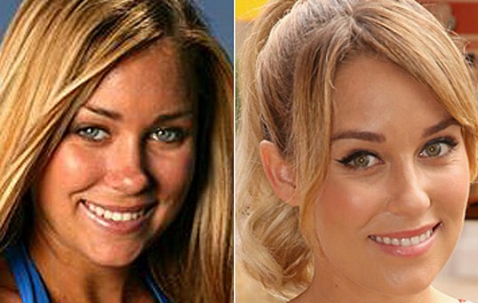 Lauren Conrad Plastic Surgery Before After